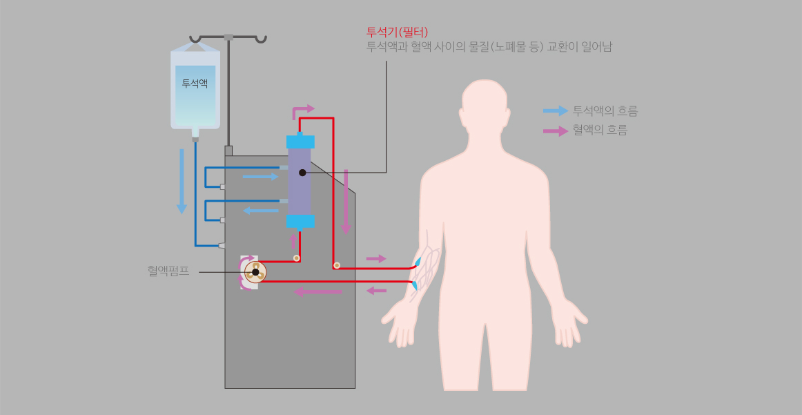 투석과정