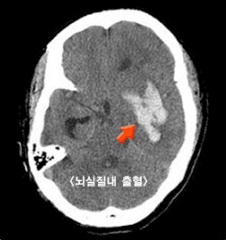 뇌실질내 출혈