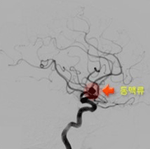 동맥류 뒷면사진