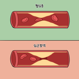 관상동맥이 좁아져 발생하는 협심증, 심근경색