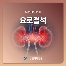 여름철 발생가능성이 높은 요로결석