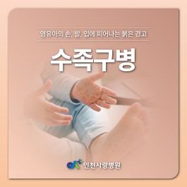 여름철 발생 가능성이 높은 수족구병